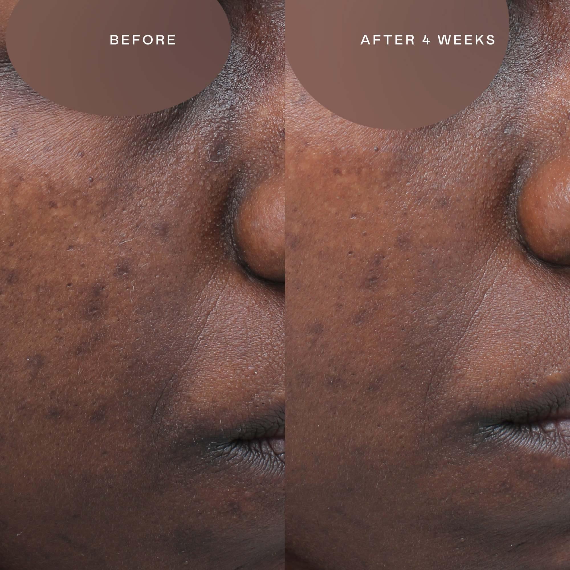 hyperpigmentation treatment for black skin before and after | EADEM