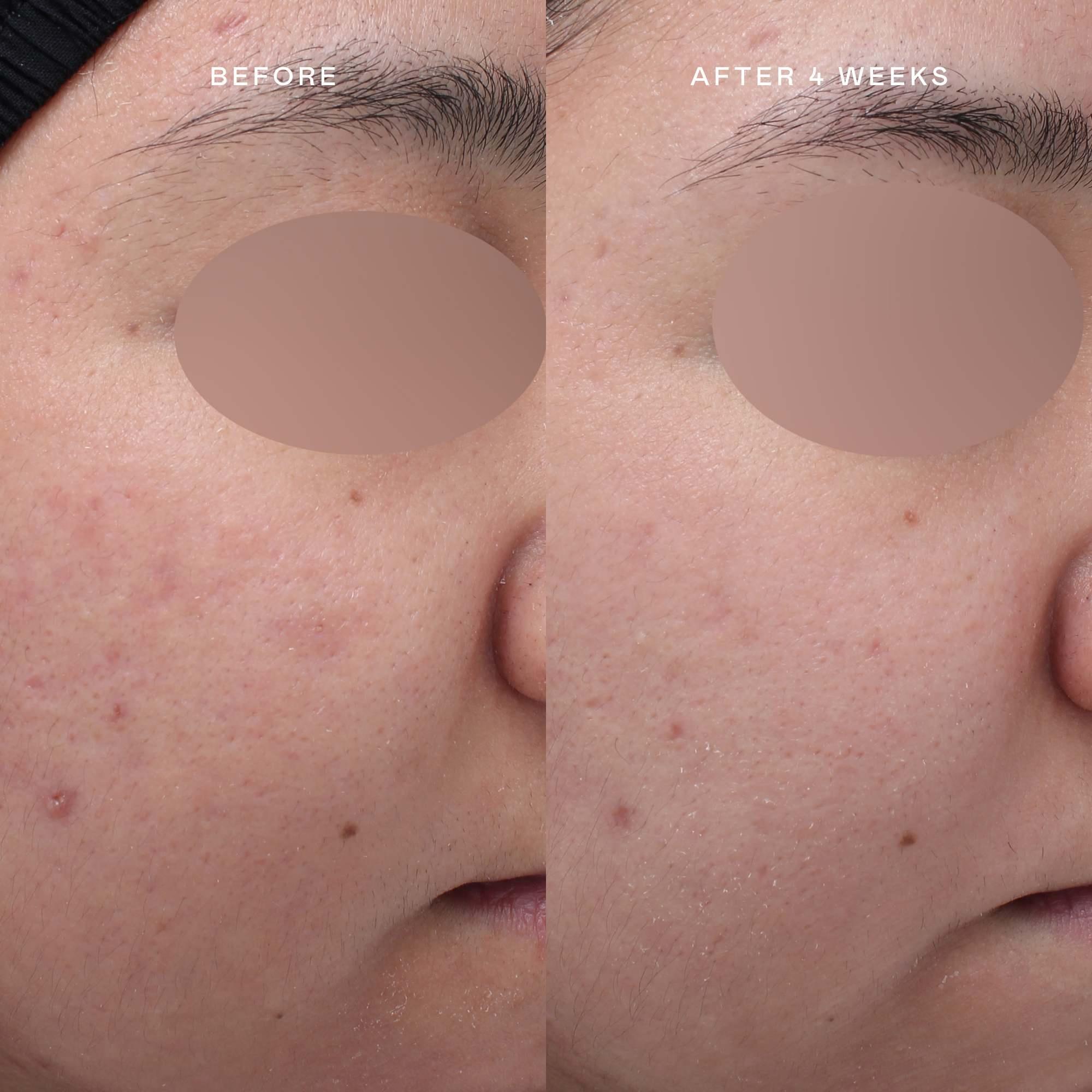 before and after hyperpigmentation treatment and acne scars | EADEM