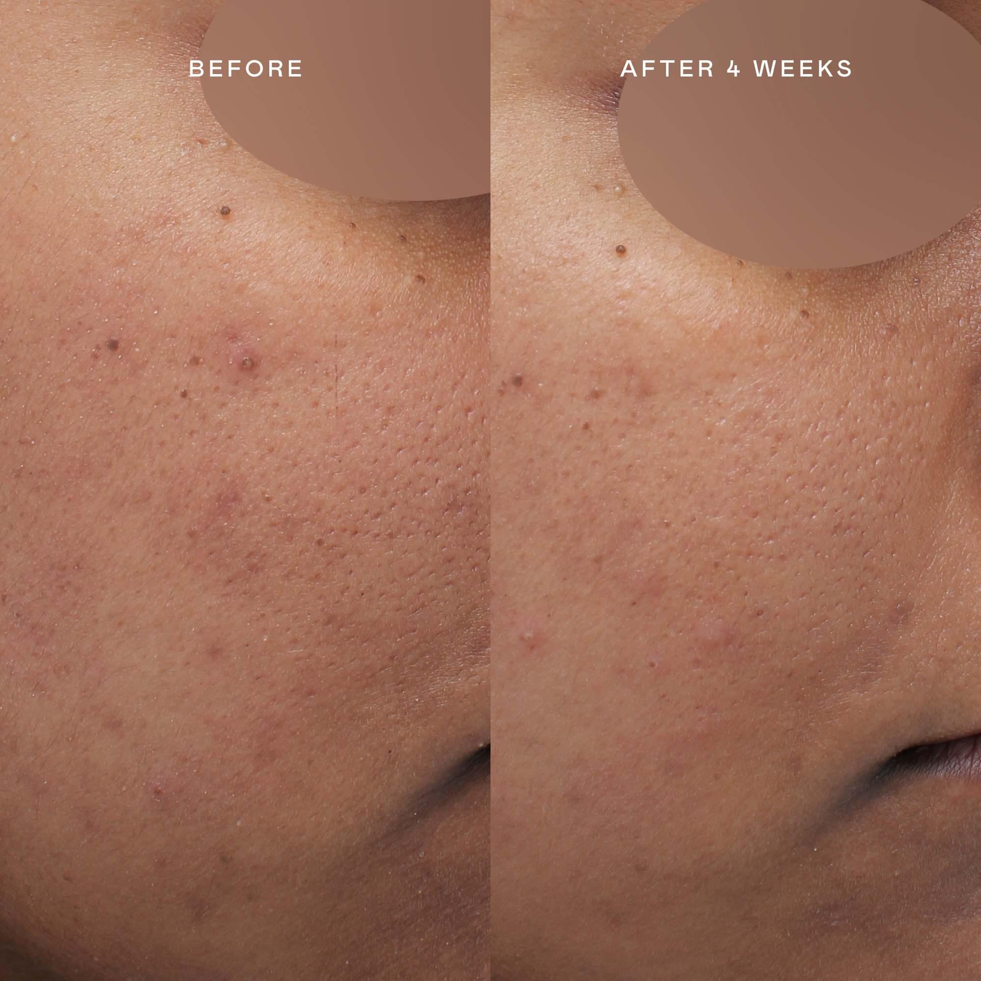 before and after brighter, not lighter skin care kit for women of color, best skincare for black women | EADEM